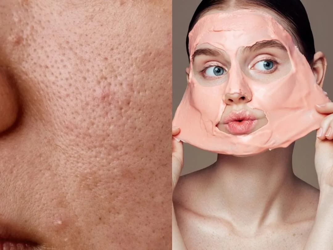 Jak wygląda zapchana cera? Poznaj objawy i sposoby leczenia